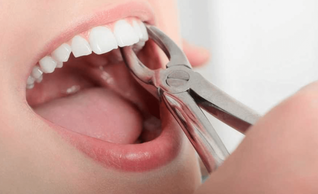 mulher arrancando dente no dentista