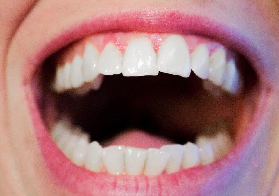pessoa sorrindo com os dentes tortos